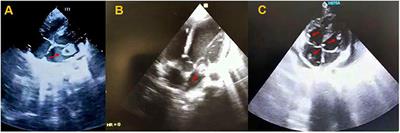 Case Report: Acute Intracardiac Thrombosis in Children With Coronavirus Disease 2019 (COVID-19)